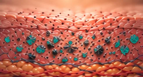 Illustration of step 3: Epidermal disruption