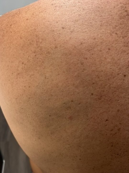 After laser tattoo removal