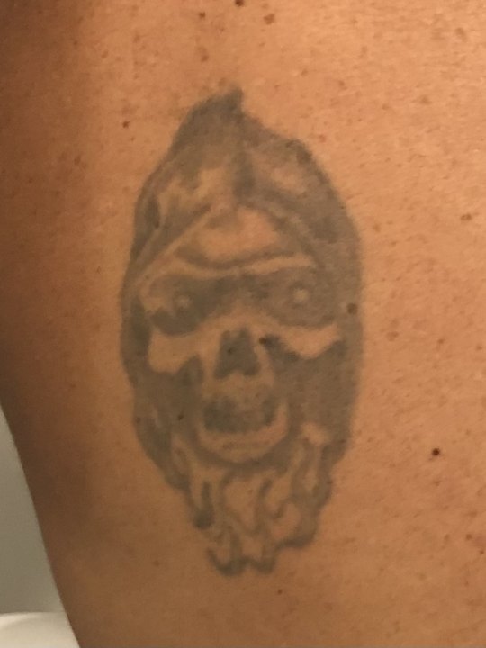 Before laser tattoo removal