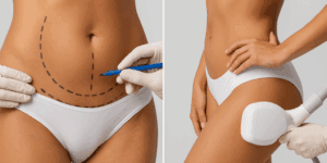 Body Sculpting Surgery vs Non-Surgical Options